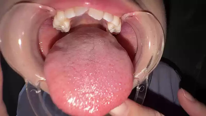 【個人撮影】谷田かりな 開口器で口内観察デカ舌を要チェック